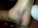 Favre ankle